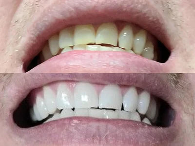 Caeloria LED Teeth Whitening Mouthpiece