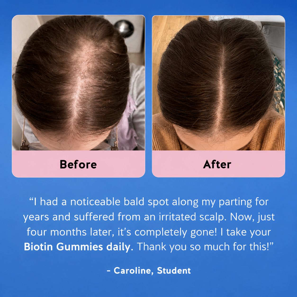 Biotin Gummies for Hair Growth